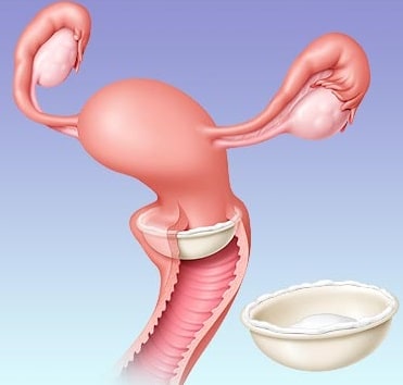 metodo contraccettivo femminile diaframma